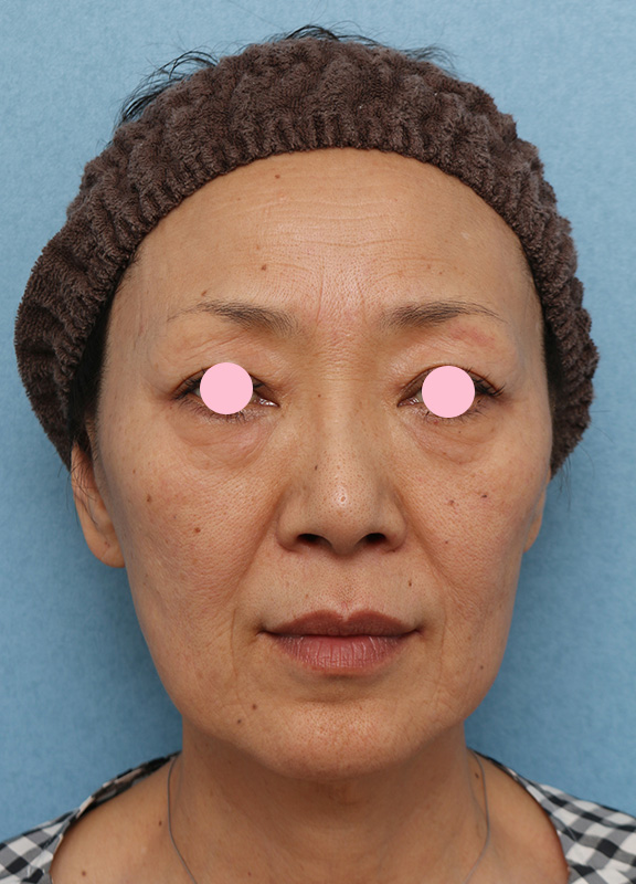 Vシェイプリフト（ヒアルロン酸注射）,フェイスラインと目の下たるみをヒアルロン酸注射で改善させた症例写真,Before,ba_v_shapelift005_b01.jpg