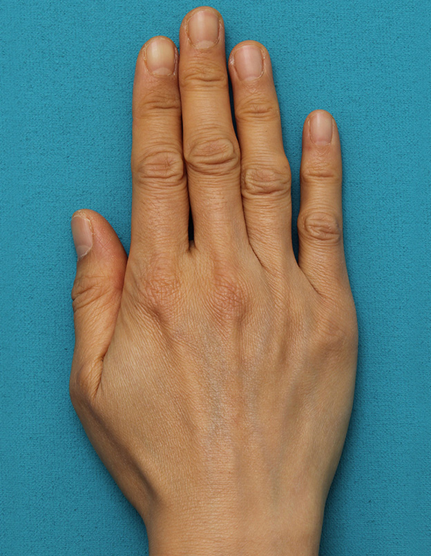 注射式シワ取り 長期持続型ヒアルロン酸注入,手の甲をふっくらさせるヒアルロン酸注射の症例写真,注入前,mainpic_hyaluronic033a.jpg