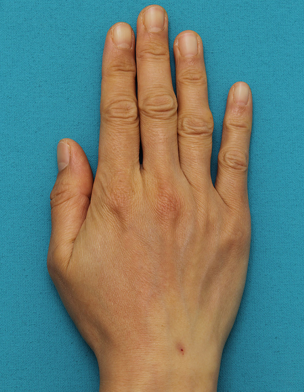 注射式シワ取り 長期持続型ヒアルロン酸注入,手の甲をふっくらさせるヒアルロン酸注射の症例写真,注入直後,mainpic_hyaluronic033b.jpg