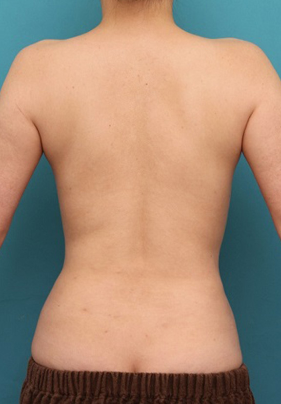 脂肪吸引,背中、ウエスト、腰から脂肪吸引し、バスト脂肪注入した症例写真,After（6ヶ月後）,ba_inject023_b04.jpg