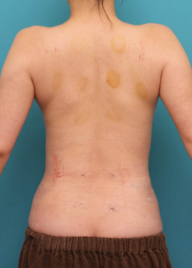 脂肪吸引,背中、ウエスト、腰から脂肪吸引し、バスト脂肪注入した症例写真,手術直後（脂肪吸引直後）,mainpic_inject023g.jpg