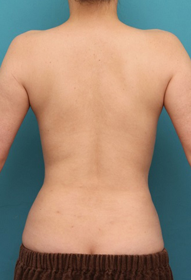 脂肪吸引,背中、ウエスト、腰から脂肪吸引し、バスト脂肪注入した症例写真,6ヶ月後,mainpic_inject023j.jpg