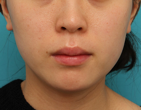 あご注射（ヒアルロン酸）,長期持続型ヒアルロン酸注射で顎先を下に伸ばさないように前に出して尖らせた症例写真,After（1ヶ月後）,ba_agochu013_b01.jpg