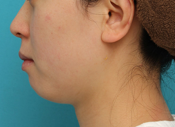 あご注射（ヒアルロン酸）,長期持続型ヒアルロン酸注射で顎先を下に伸ばさないように前に出して尖らせた症例写真,Before,ba_agochu013_b03.jpg