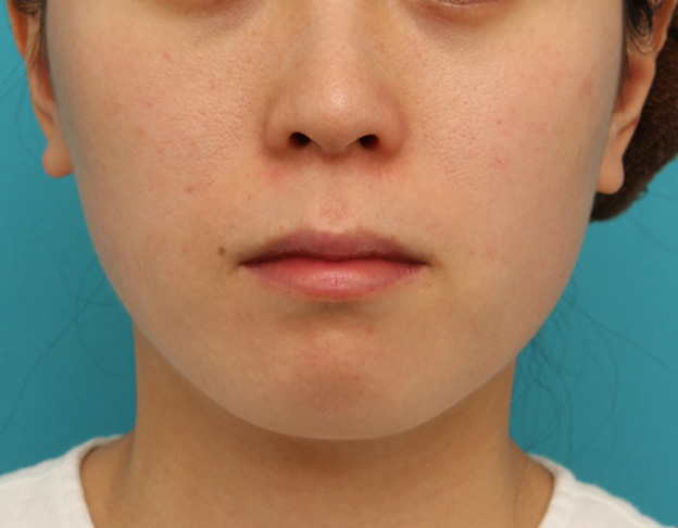 あご注射（ヒアルロン酸）,長期持続型ヒアルロン酸注射で顎先を下に伸ばさないように前に出して尖らせた症例写真,治療前,mainpic_agochu013a.jpg