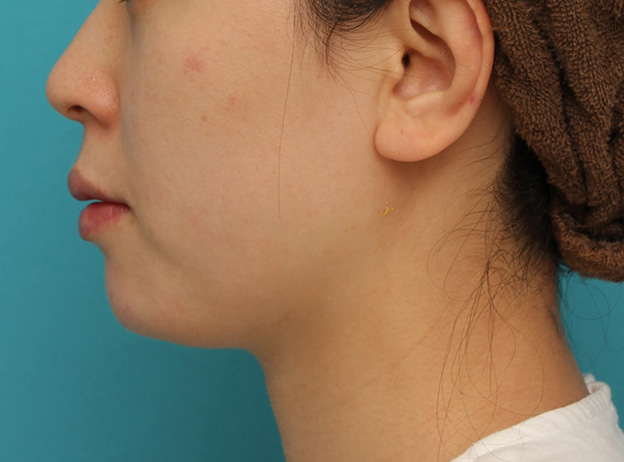 あご注射（ヒアルロン酸）,長期持続型ヒアルロン酸注射で顎先を下に伸ばさないように前に出して尖らせた症例写真,注射直後,mainpic_agochu013f.jpg