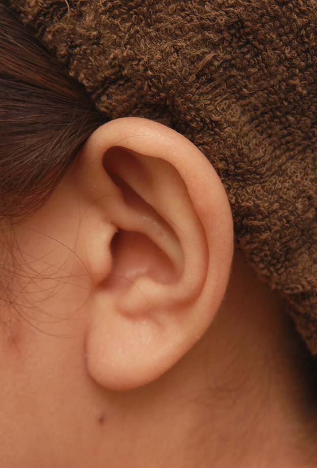 耳介軟骨移植（鼻先を出す）,耳介軟骨移植と小鼻（鼻翼）縮小を同時に行った症例写真,手術前,mainpic_biyoku045k.jpg