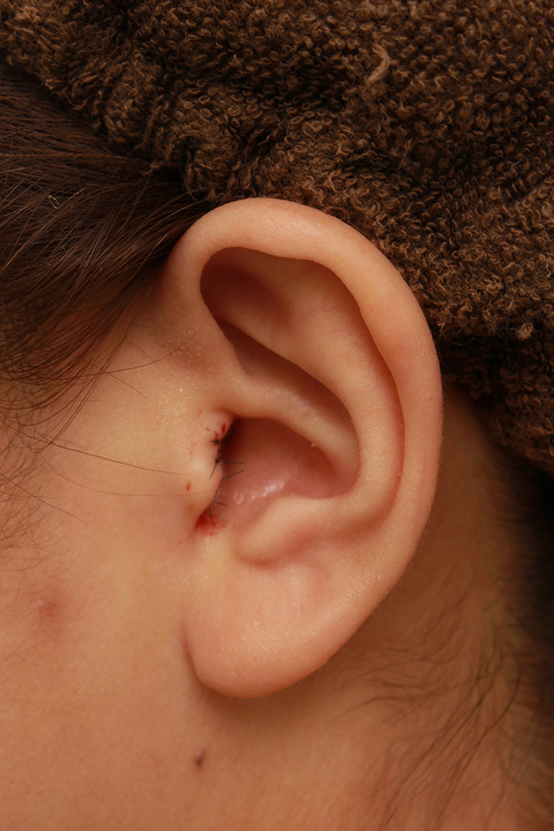 耳介軟骨移植（鼻先を出す）,耳介軟骨移植と小鼻（鼻翼）縮小を同時に行った症例写真,手術直後,mainpic_biyoku045l.jpg