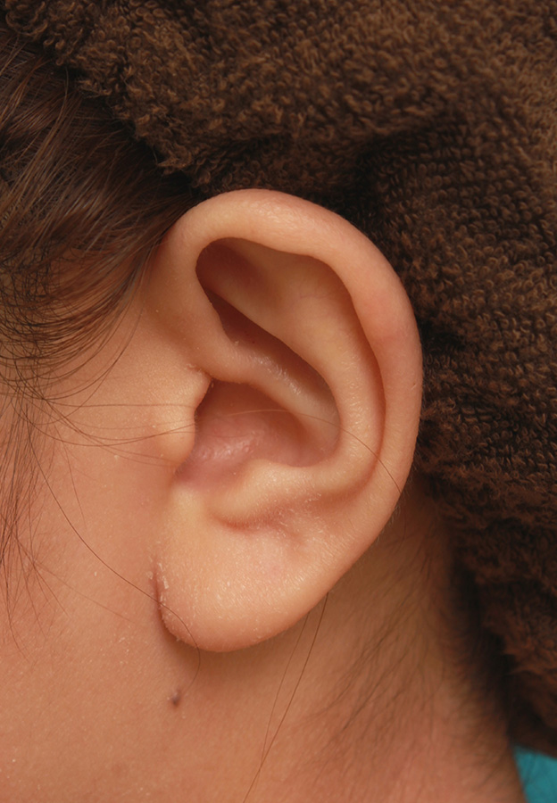 耳介軟骨移植（鼻先を出す）,耳介軟骨移植と小鼻（鼻翼）縮小を同時に行った症例写真,3週間後,mainpic_biyoku045n.jpg