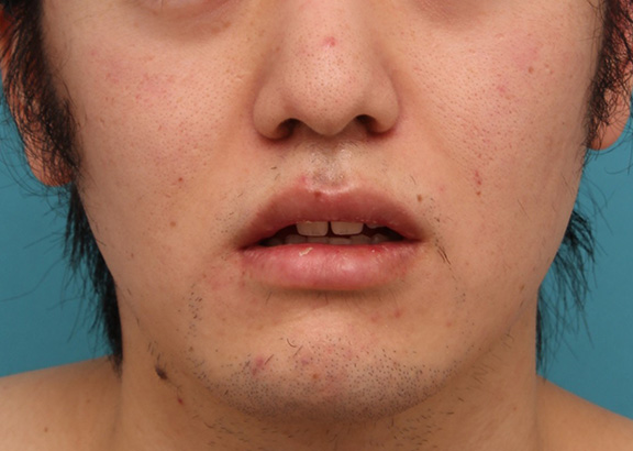 唇を薄く（口唇縮小術）,明らかに厚い唇を手術で薄くして平均サイズくらいにした20代男性の症例写真,After（6ヶ月後）,ba_usuku010_b02.jpg