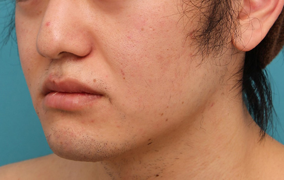 唇を薄く（口唇縮小術）,明らかに厚い唇を手術で薄くして平均サイズくらいにした20代男性の症例写真,After（6ヶ月後）,ba_usuku010_b03.jpg