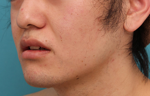 唇を薄く（口唇縮小術）,明らかに厚い唇を手術で薄くして平均サイズくらいにした20代男性の症例写真,After（6ヶ月後）,ba_usuku010_b04.jpg