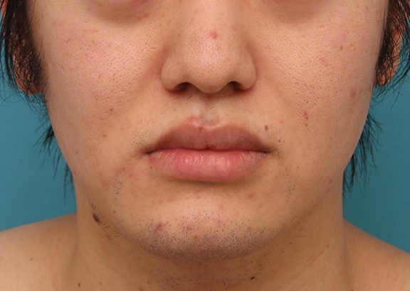 症例写真,明らかに厚い唇を手術で薄くして平均サイズくらいにした20代男性の症例写真,Before,ba_usuku010_b01.jpg