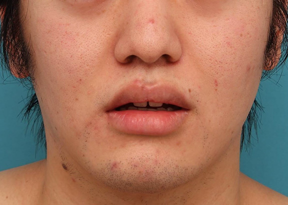 唇を薄く（口唇縮小術）,明らかに厚い唇を手術で薄くして平均サイズくらいにした20代男性の症例写真,Before,ba_usuku010_b02.jpg