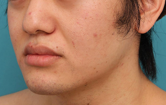唇を薄く（口唇縮小術）,明らかに厚い唇を手術で薄くして平均サイズくらいにした20代男性の症例写真,Before,ba_usuku010_b03.jpg