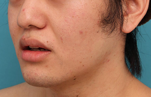 唇を薄く（口唇縮小術）,明らかに厚い唇を手術で薄くして平均サイズくらいにした20代男性の症例写真,Before,ba_usuku010_b04.jpg