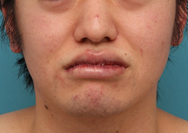 唇を薄く（口唇縮小術）,明らかに厚い唇を手術で薄くして平均サイズくらいにした20代男性の症例写真,手術直後,口を閉じた状態,mainpic_usuku010c.jpg