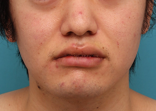 唇を薄く（口唇縮小術）,明らかに厚い唇を手術で薄くして平均サイズくらいにした20代男性の症例写真,5日後,口を閉じた状態,mainpic_usuku010e.jpg