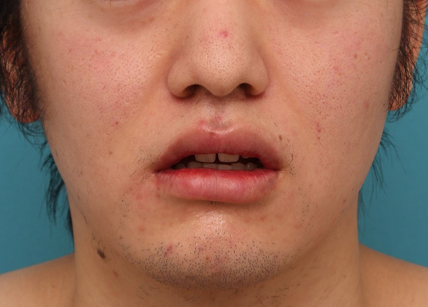 唇を薄く（口唇縮小術）,明らかに厚い唇を手術で薄くして平均サイズくらいにした20代男性の症例写真,8日後,口を半開きにした状態,mainpic_usuku010h.jpg