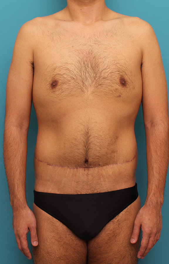 腹リダクション（お腹のたるみ取り）,お腹の皮膚のたるみとり手術（腹部リダクション）を行った30代男性の症例写真,After（6ヶ月後）,ba_hara002_a01.jpg