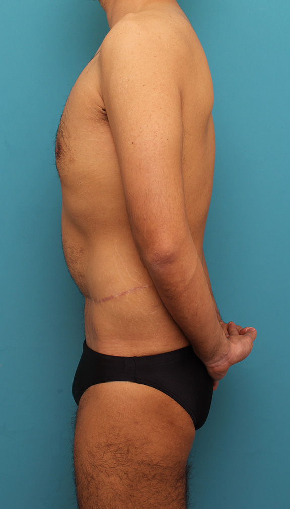 腹リダクション（お腹のたるみ取り）,お腹の皮膚のたるみとり手術（腹部リダクション）を行った30代男性の症例写真,After（6ヶ月後）,ba_hara002_b05.jpg