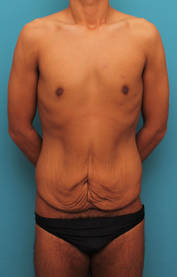 お腹の皮膚のたるみとり手術（腹部リダクション）を行った30代男性の症例写真,Before,ba_hara002_b01.jpg