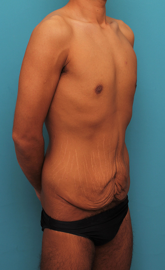 腹リダクション（お腹のたるみ取り）,お腹の皮膚のたるみとり手術（腹部リダクション）を行った30代男性の症例写真,Before,ba_hara002_b02.jpg