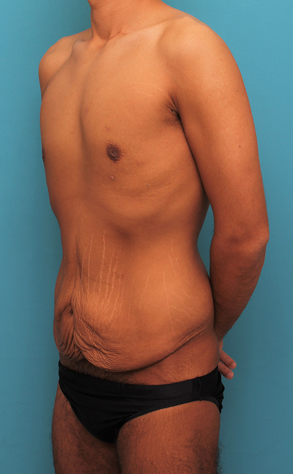 腹リダクション（お腹のたるみ取り）,お腹の皮膚のたるみとり手術（腹部リダクション）を行った30代男性の症例写真,Before,ba_hara002_b04.jpg