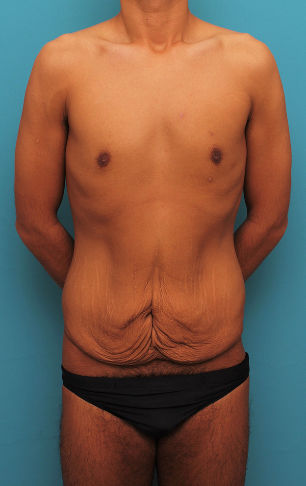腹リダクション（お腹のたるみ取り）,お腹の皮膚のたるみとり手術（腹部リダクション）を行った30代男性の症例写真,手術前,mainpic_hara002a.jpg