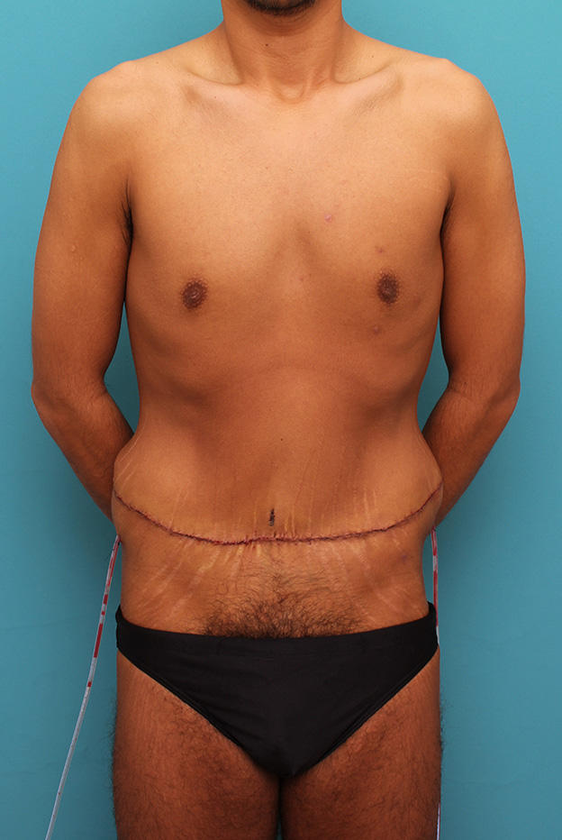 腹リダクション（お腹のたるみ取り）,お腹の皮膚のたるみとり手術（腹部リダクション）を行った30代男性の症例写真,手術直後,mainpic_hara002b.jpg