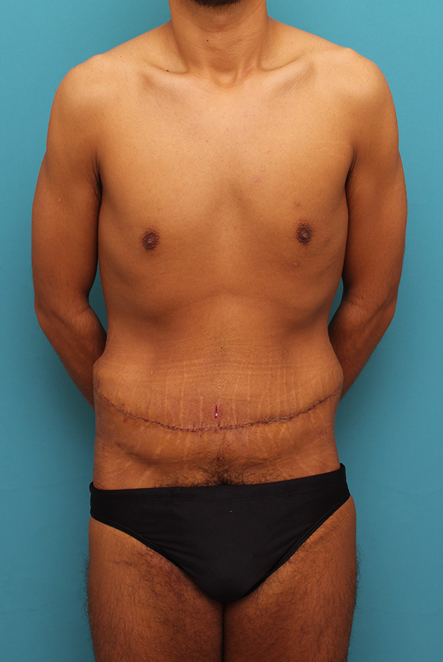 腹リダクション（お腹のたるみ取り）,お腹の皮膚のたるみとり手術（腹部リダクション）を行った30代男性の症例写真,1週間後,mainpic_hara002c.jpg