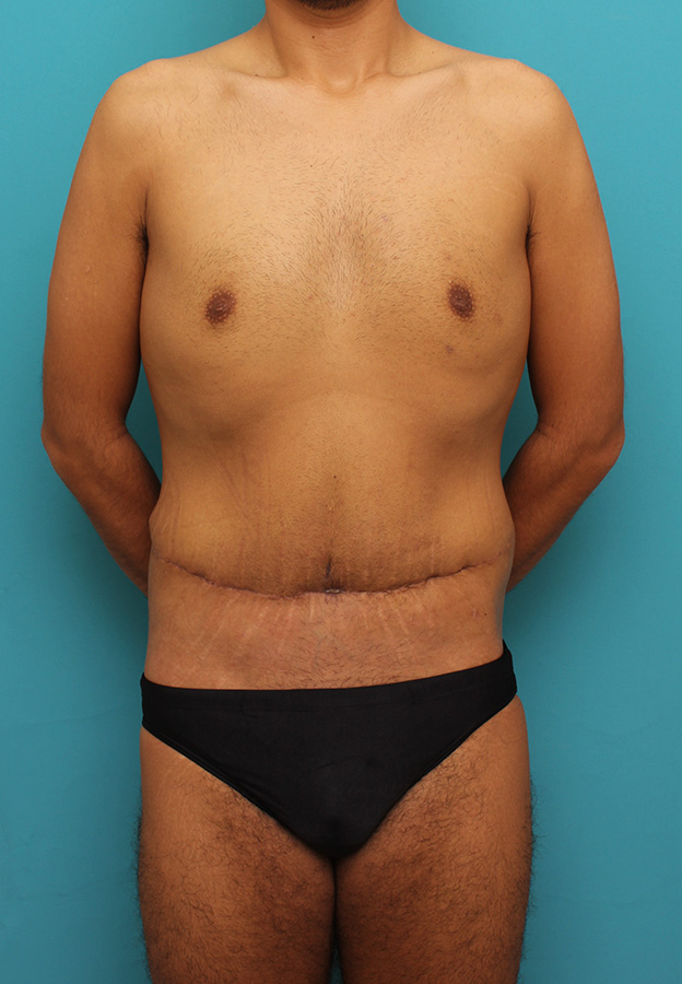 腹リダクション（お腹のたるみ取り）,お腹の皮膚のたるみとり手術（腹部リダクション）を行った30代男性の症例写真,3週間後,mainpic_hara002d.jpg