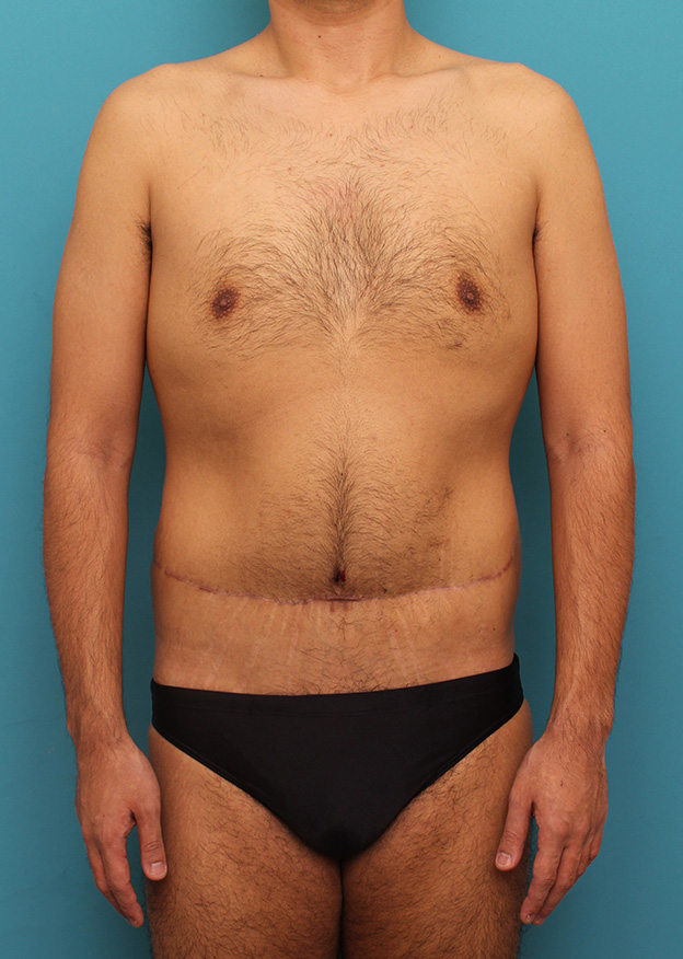 腹リダクション（お腹のたるみ取り）,お腹の皮膚のたるみとり手術（腹部リダクション）を行った30代男性の症例写真,6ヶ月後,mainpic_hara002e.jpg