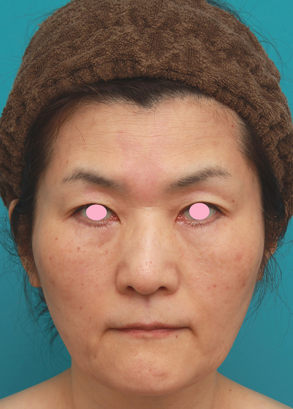 症例写真,50代後半女性のたるんだ顔に脂肪溶解注射を行って小顔にした症例写真,After（4回目注射後）,ba_meso_face009_b01.jpg
