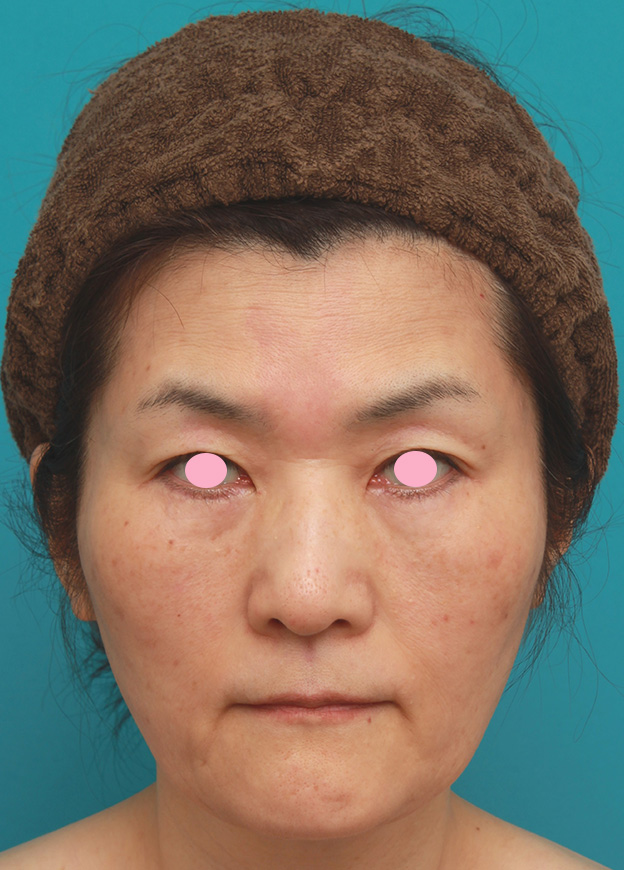 小顔専用脂肪溶解注射メソシェイプフェイス,50代後半女性のたるんだ顔に脂肪溶解注射を行って小顔にした症例写真,4回目注射後,mainpic_meso_face009e.jpg