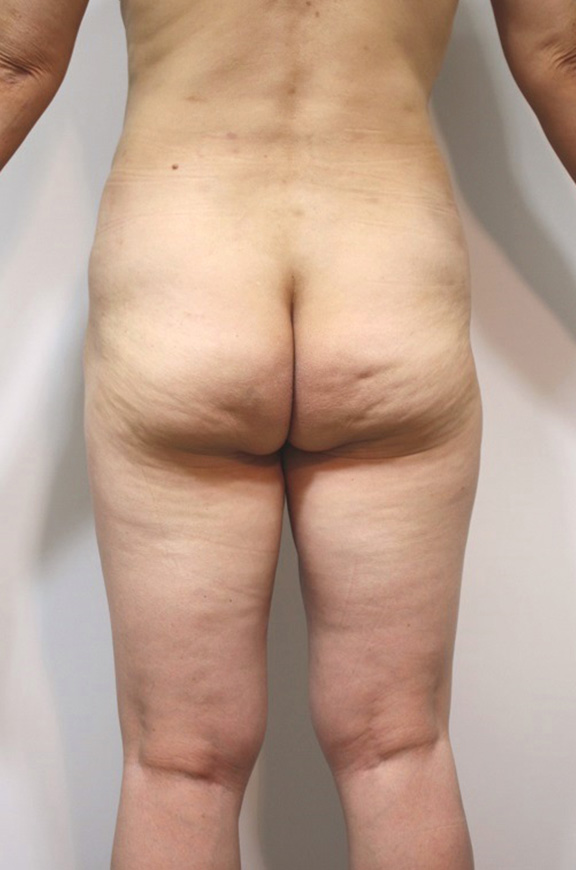 脂肪吸引,腰、ウェスト、お尻の脂肪吸引をして、後ろ姿が改善した50代女性の症例写真,After（手術後）,ba_shibokyuin038_b01.jpg