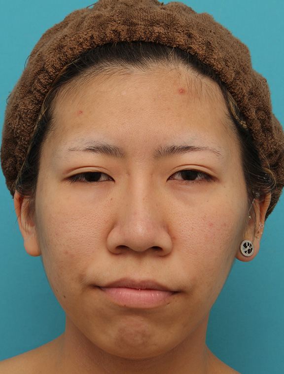 隆鼻術（シリコンプロテーゼ）,20代女性の、総合的なお鼻のお悩みを手術で改善した症例写真,After（6ヶ月後メイクなし）,ba_ryubi1052_b01.jpg