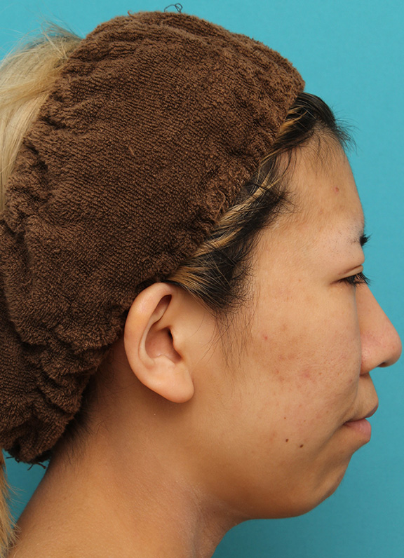 鼻翼縮小（小鼻縮小）,20代女性の、総合的なお鼻のお悩みを手術で改善した症例写真,After（6ヶ月後）,ba_ryubi1052_b02.jpg