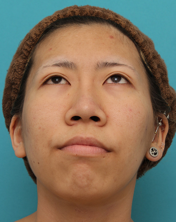 耳介軟骨移植（鼻先を出す）,20代女性の、総合的なお鼻のお悩みを手術で改善した症例写真,After（6ヶ月後メイクなし）,ba_ryubi1052_b04.jpg