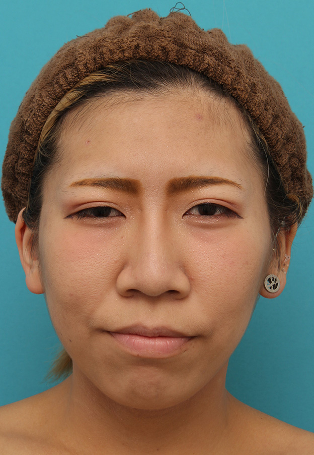 耳介軟骨移植（鼻先を出す）,20代女性の、総合的なお鼻のお悩みを手術で改善した症例写真,After（6ヶ月後メイクあり）,