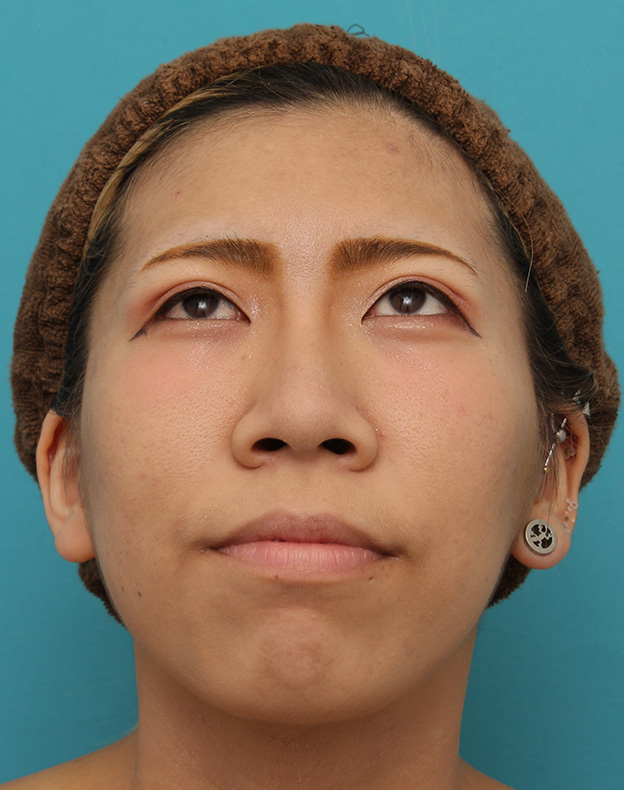 鼻翼縮小（小鼻縮小）,20代女性の、総合的なお鼻のお悩みを手術で改善した症例写真,After（6ヶ月後メイクあり）,
