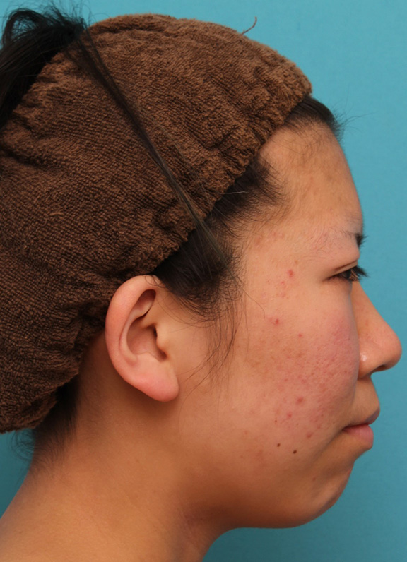 隆鼻術（シリコンプロテーゼ）,20代女性の、総合的なお鼻のお悩みを手術で改善した症例写真,Before,ba_ryubi1052_b02.jpg