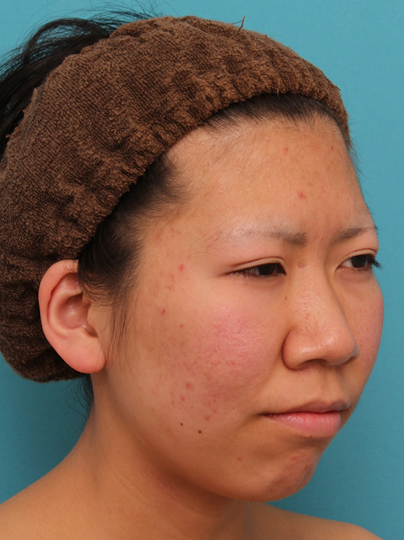 鼻翼縮小（小鼻縮小）,20代女性の、総合的なお鼻のお悩みを手術で改善した症例写真,Before,ba_ryubi1052_b03.jpg