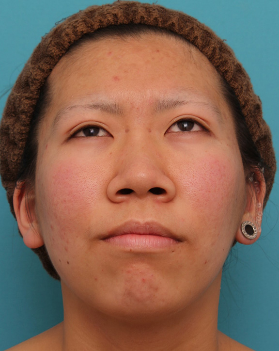 鼻翼縮小（小鼻縮小）,20代女性の、総合的なお鼻のお悩みを手術で改善した症例写真,Before,ba_ryubi1052_b04.jpg
