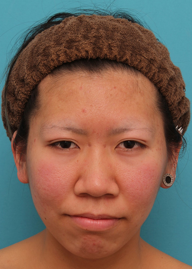 隆鼻術（シリコンプロテーゼ）,20代女性の、総合的なお鼻のお悩みを手術で改善した症例写真,手術前,mainpic_ryubi1052a.jpg