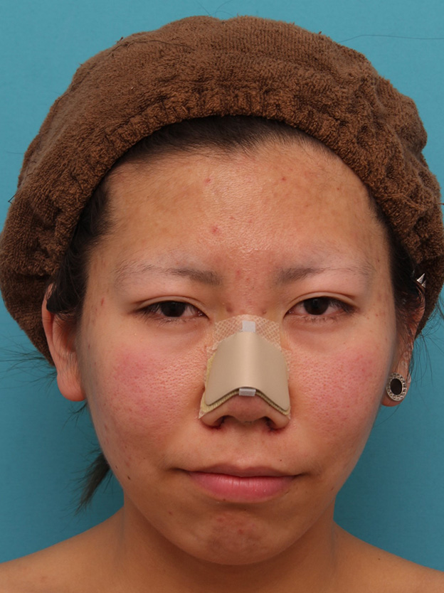 鼻翼縮小（小鼻縮小）,20代女性の、総合的なお鼻のお悩みを手術で改善した症例写真,手術直後,mainpic_ryubi1052b.jpg