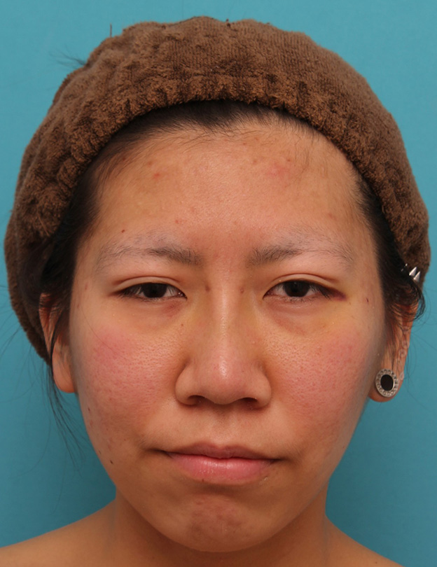 耳介軟骨移植（鼻先を出す）,20代女性の、総合的なお鼻のお悩みを手術で改善した症例写真,1週間後,mainpic_ryubi1052c.jpg