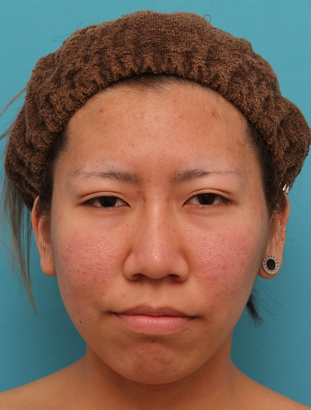 隆鼻術（シリコンプロテーゼ）,20代女性の、総合的なお鼻のお悩みを手術で改善した症例写真,1ヶ月後,mainpic_ryubi1052d.jpg