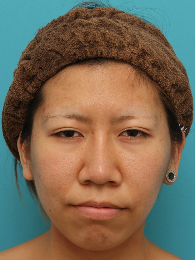 耳介軟骨移植（鼻先を出す）,20代女性の、総合的なお鼻のお悩みを手術で改善した症例写真,3ヶ月後,mainpic_ryubi1052e.jpg