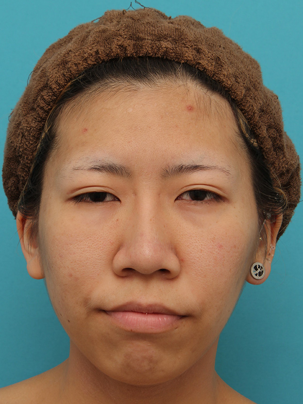 耳介軟骨移植（鼻先を出す）,20代女性の、総合的なお鼻のお悩みを手術で改善した症例写真,6ヶ月後,メイクなし,mainpic_ryubi1052f.jpg